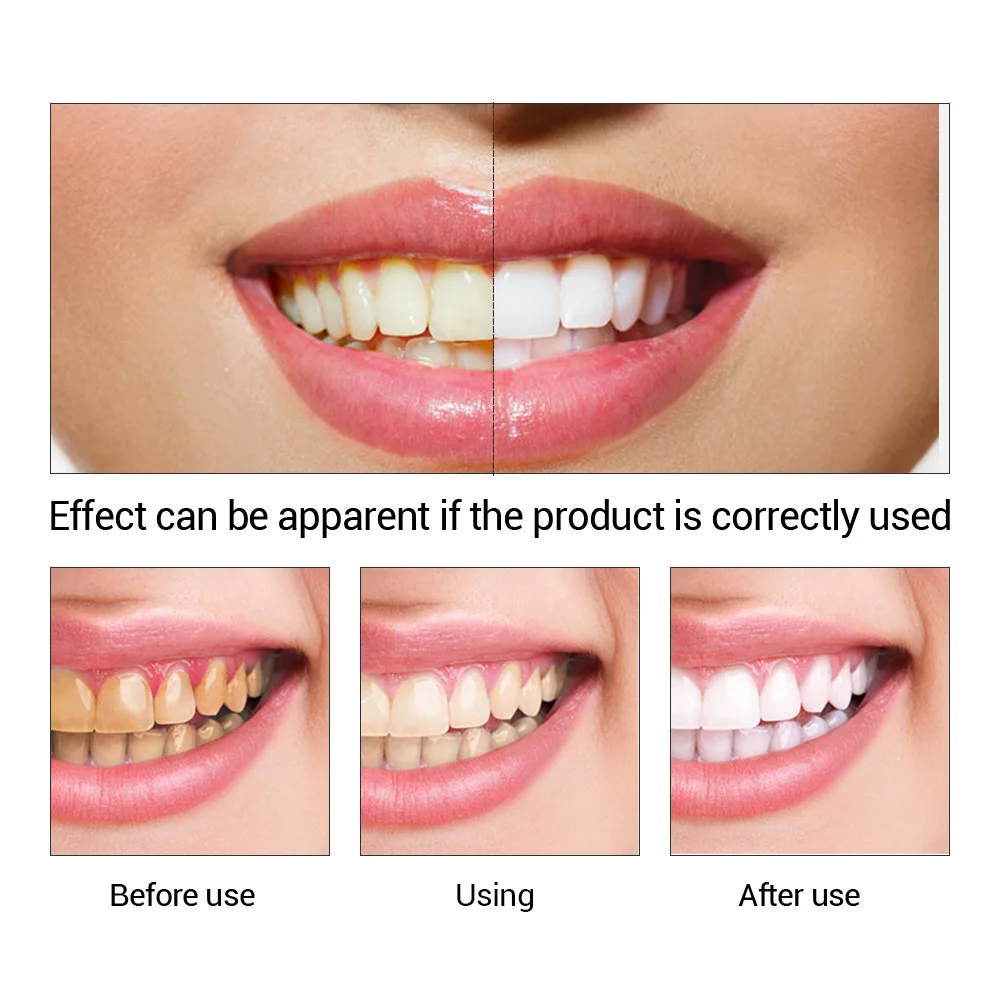 FTEENPLY diş beyazlatma özü to - Teeth Whitening Singapore incelemesi ve fiyatı